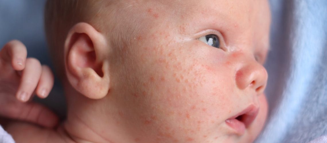 Bébé a de l’acné : que faire ? Comment la traiter ? Bébé a de l'acné : que faire ? Comment la traiter ?